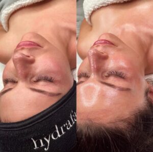 HydraFacial Zürich Seefeld