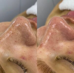 Hautreinigung HydraFacial Zürich