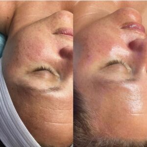 HydraFacial Zürich bestes Studio