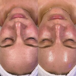 HydraFacial Studio Zürich